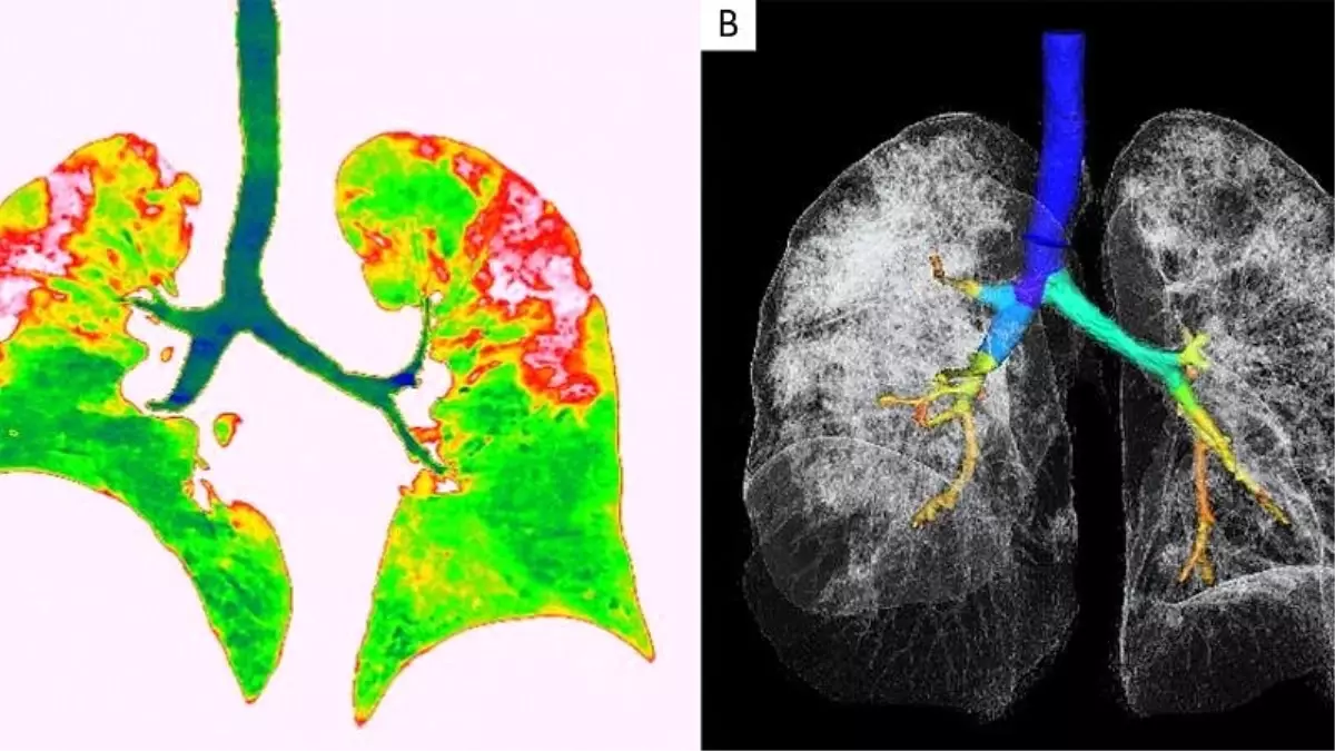 Covid-19\'un akciğerlere verdiği zararı gösteren röntgen ve tomografi görüntüleri