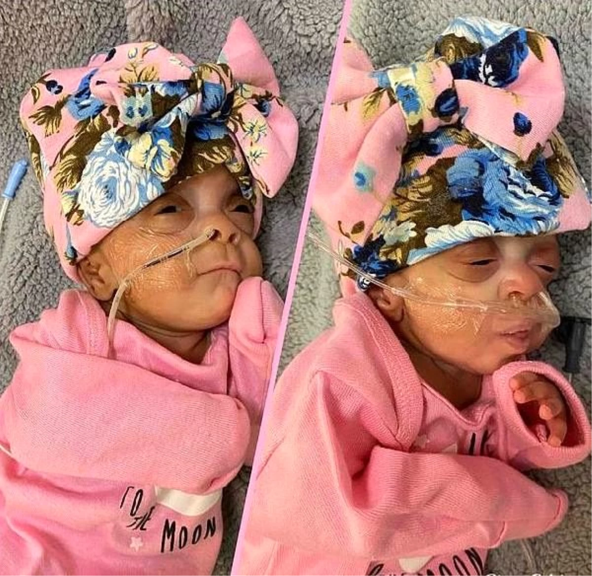 ABD\'de dünyanın en prematüre ikiz bebekleri hayata gözlerini açtı