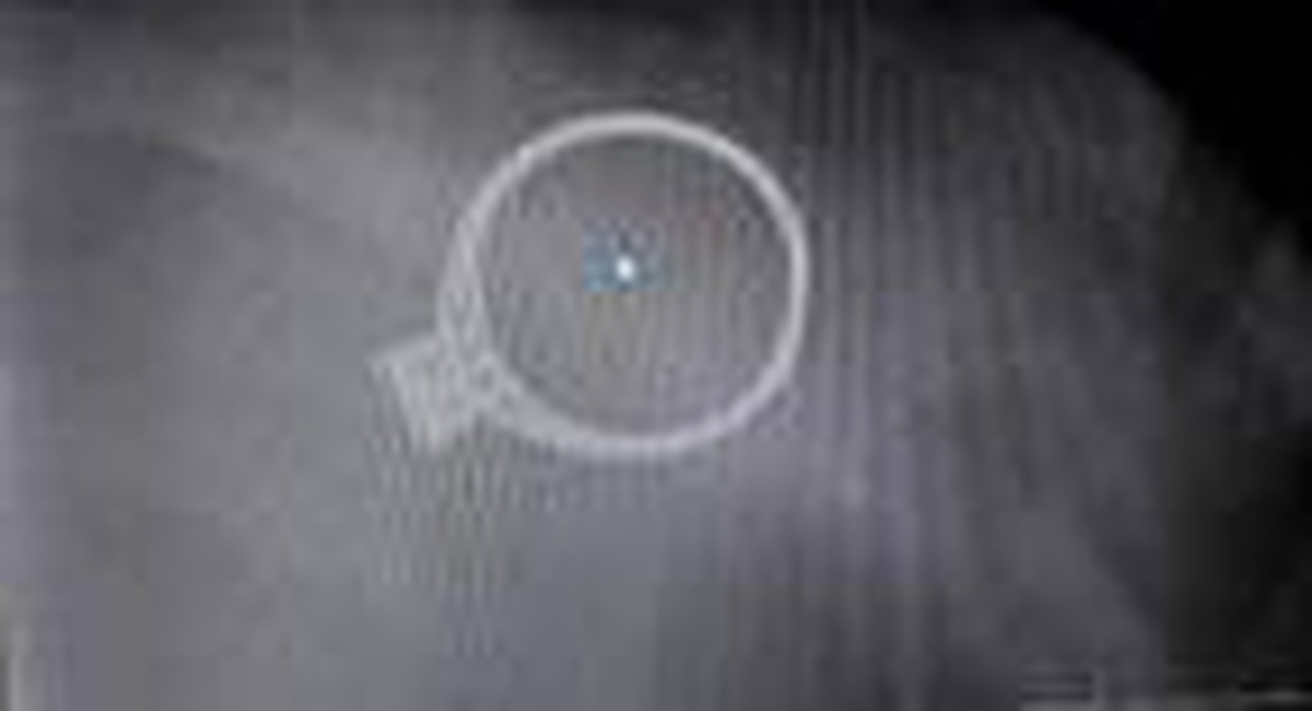 1,5 yaşındaki bebek, annesinin tek taş yüzüğünü yuttu