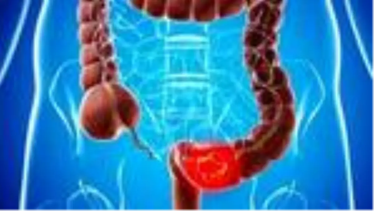 Kolon kanseri nedir, ne kadar sürer? Kolon kanseri belirtileri neler?