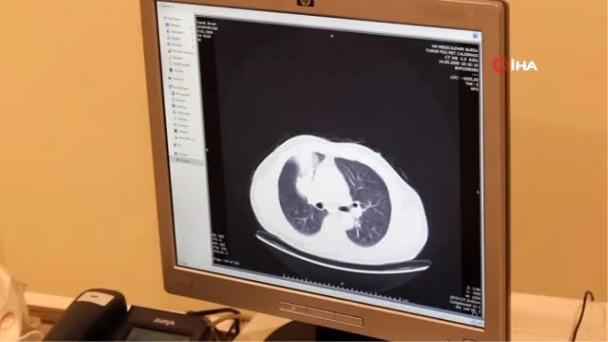 Sigara içen 40 yaş üstü vatandaşlar için akciğer tomografisi önemli