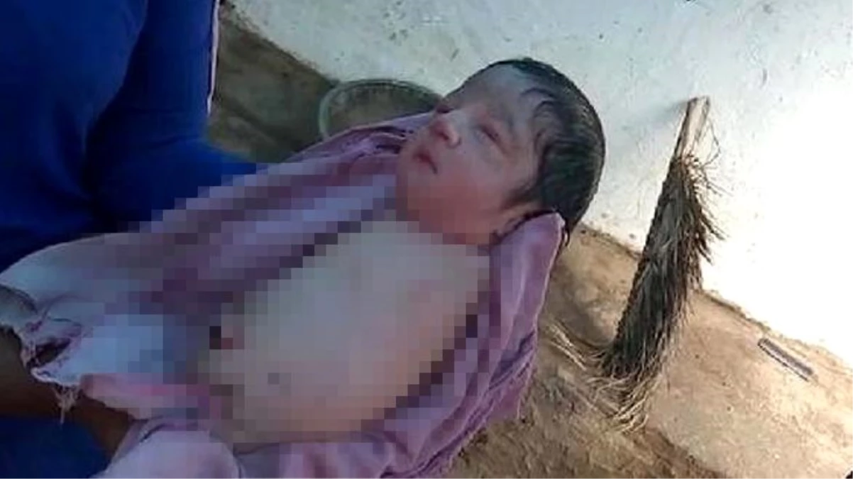 Tıp dünyası Hindistan\'da kolsuz ve bacaksız doğan kız bebeğini konuşuyor