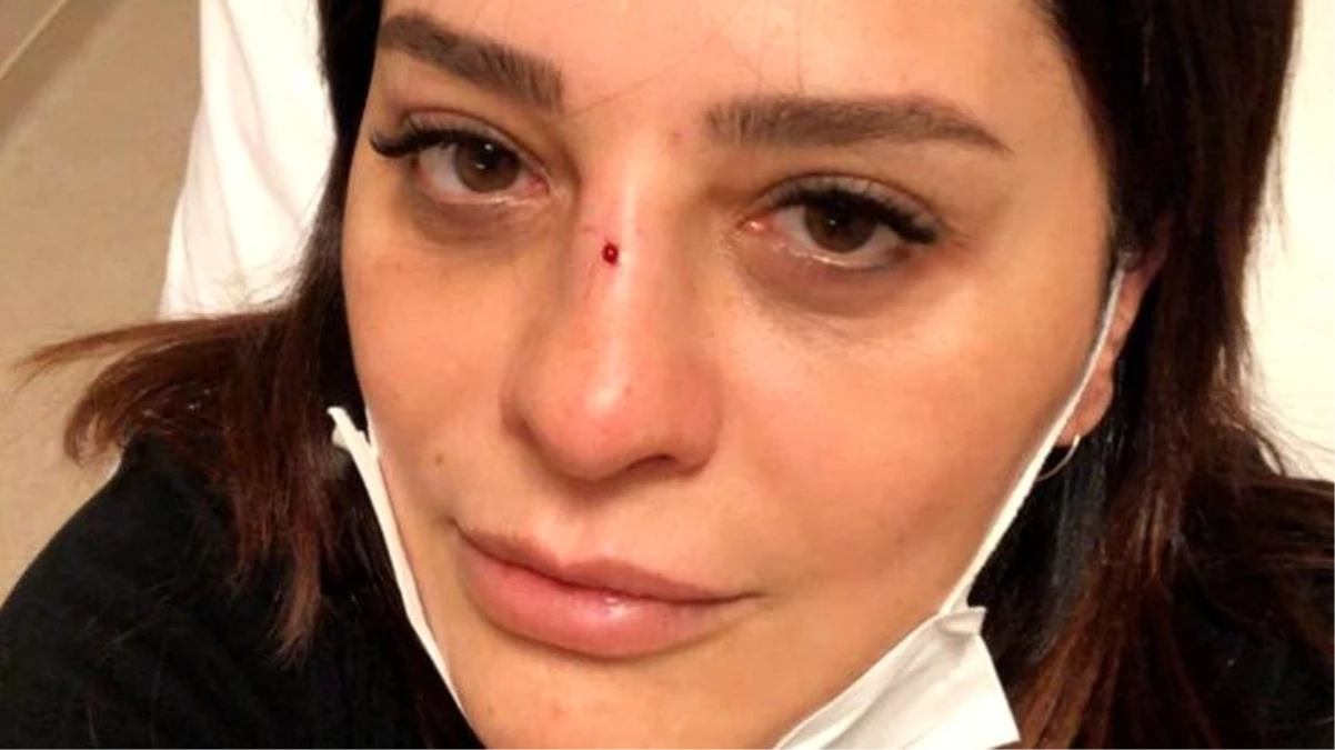 Ünlü şarkıcı Reyhan Karaca\'nın talihsiz bir şekilde burnu kırıldı