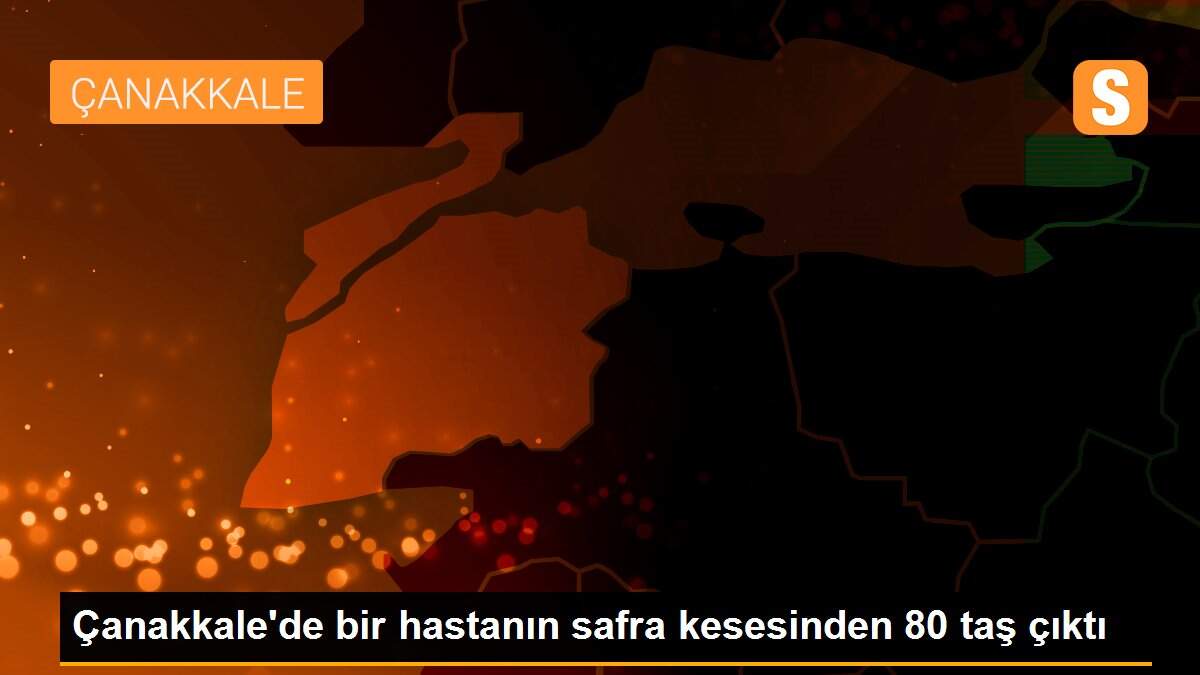 Çanakkale\'de bir hastanın safra kesesinden 80 taş çıktı