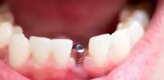 Diş implantı kanser yapar mı?