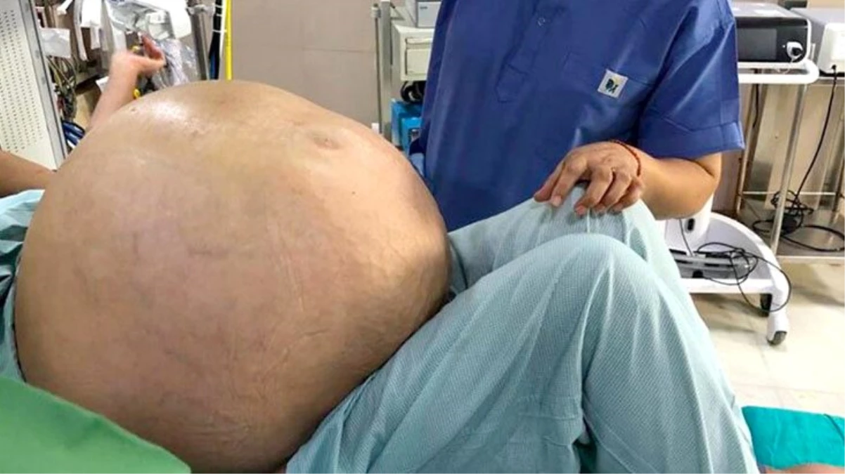 Hindistan\'da bir kadından 54 kilogram tümör çıkarıldı