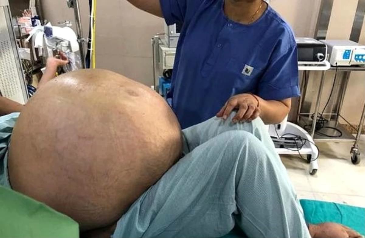 Son dakika haber! Hindistan\'da dünyanın en büyük "yumurtalık tümörü" üç saatten fazla süren operasyonla çıkarıldı