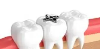 Siyah (amalgam) Dolgular