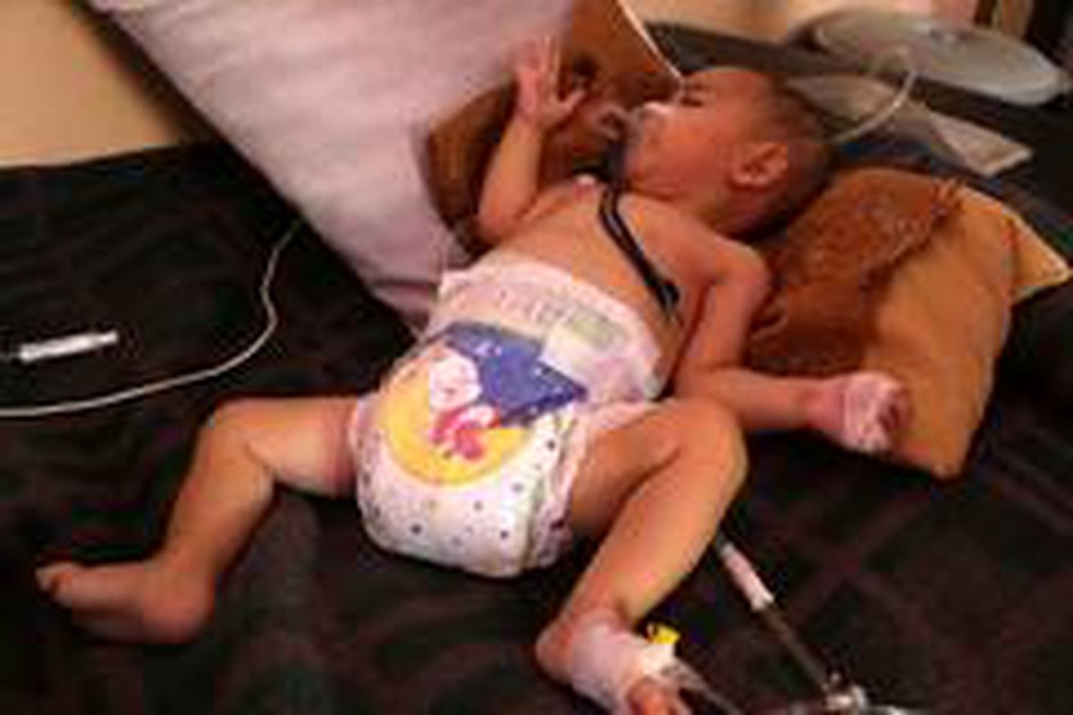 Muhammed bebek ameliyat edildi