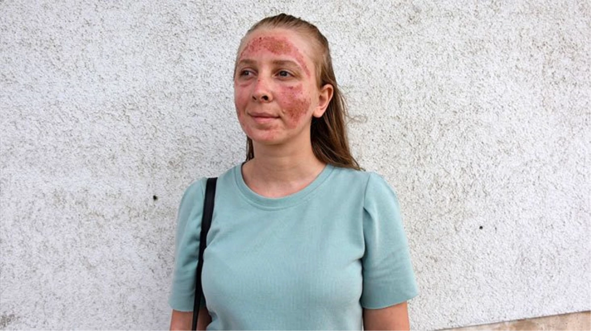 Güzellik merkezinde bakım yaptıran genç kadının yüzünde ikinci derece yanıklar oluştu