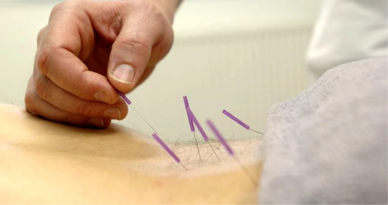 Akupunkturun kullanım alanları