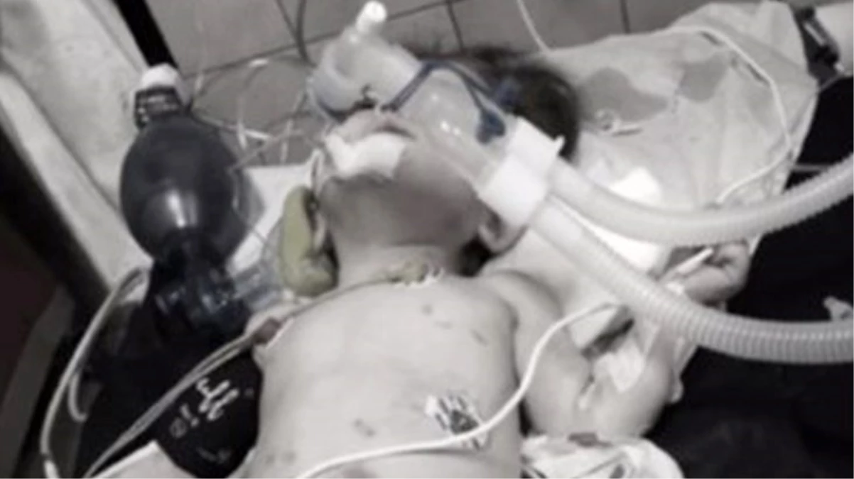 Vücudunda yanık ve yara izleriyle hastaneye kaldırılan 1 yaşındaki \'Hayat\' bebek hayatını kaybetti