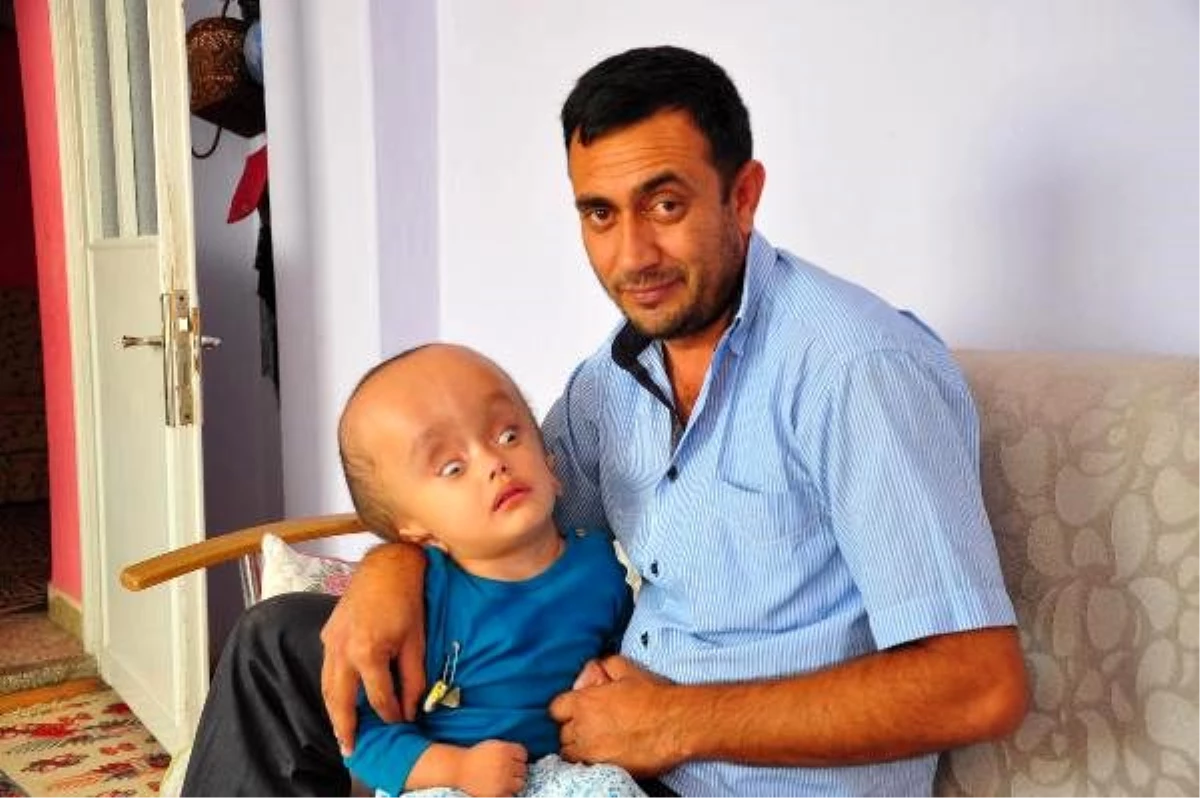 Son dakika... 2 yaşındaki hidransefali hastası Sercan\'dan sevindiren haber