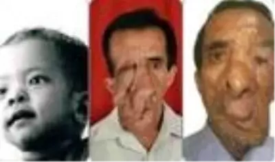 ABD'de yaşayan Nepal uyruklu kişinin yüzündeki 25 kiloluk tümör 5 ameliyatla azaltabildi ABD'de yaşayan Nepal uyruklu kişinin yüzündeki 25 kiloluk tümör 5 ameliyatla azaltabildi