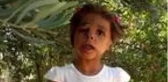 Son dakika haberleri! 5 yaşındaki Suriyeli Hane'nin 'yüzü', Türkiye'de gülecek