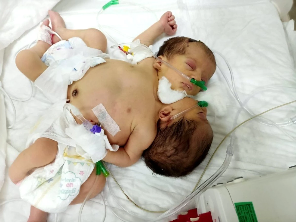 Suriye\'de dünyaya gelen yapışık siyam ikizleri Türkiye\'ye getirildi