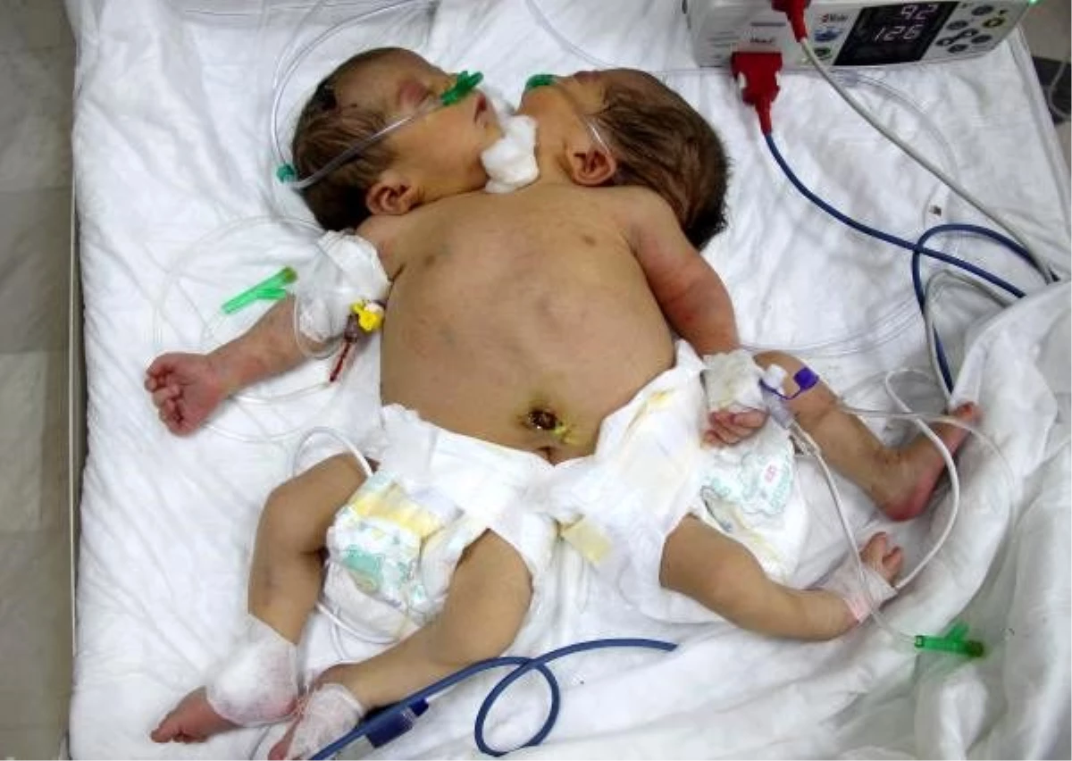 Suriye\'den getirilen tek kalple hayata tutunan \'siyam ikizleri\' tedavi altına alındı