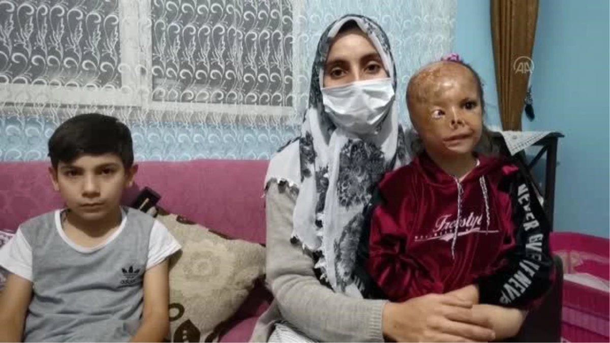Bebekken yüzü yanan Dilara\'nın ailesi yardım eli uzatılmasının sevincini yaşıyor