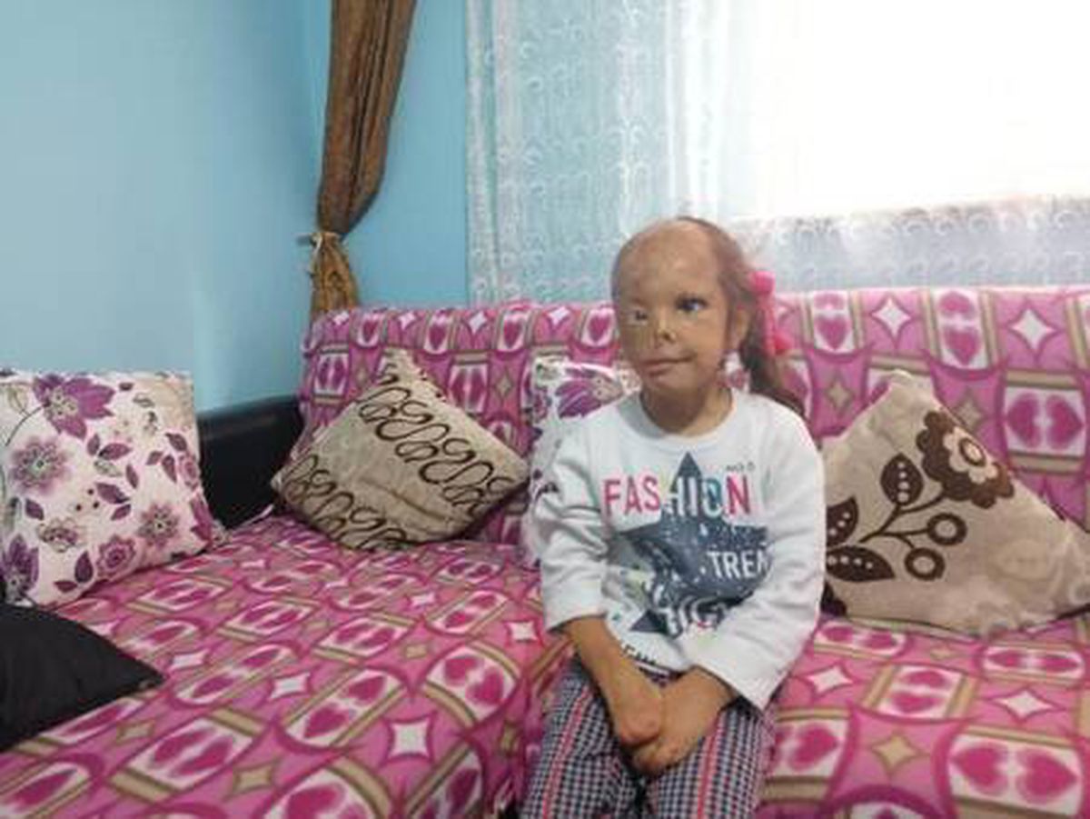 Son dakika! Yüzü yanan Dilara için Sağlık Bakanlığı devreye girdi