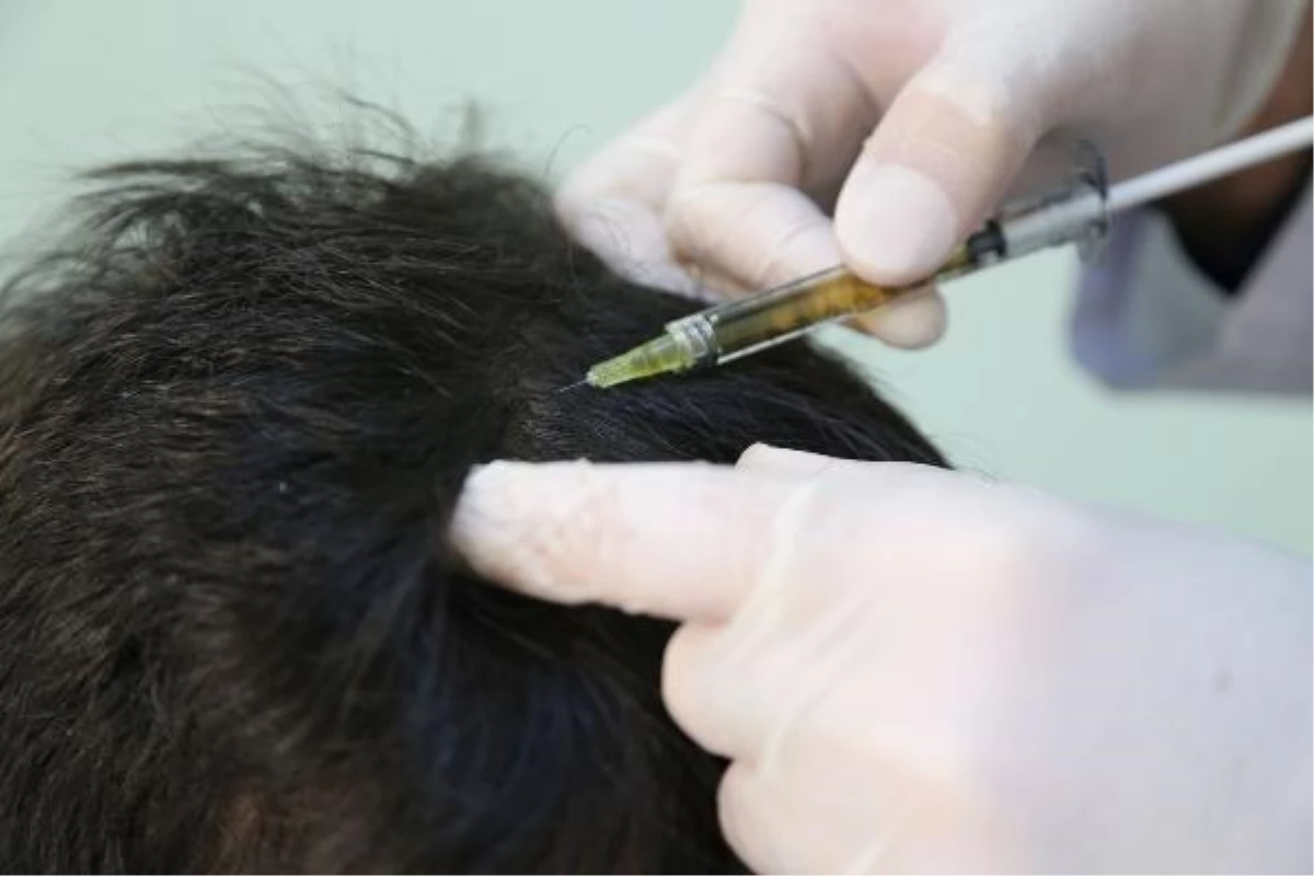 Sivas\'ta, PRP yöntemiyle saç tedavisi