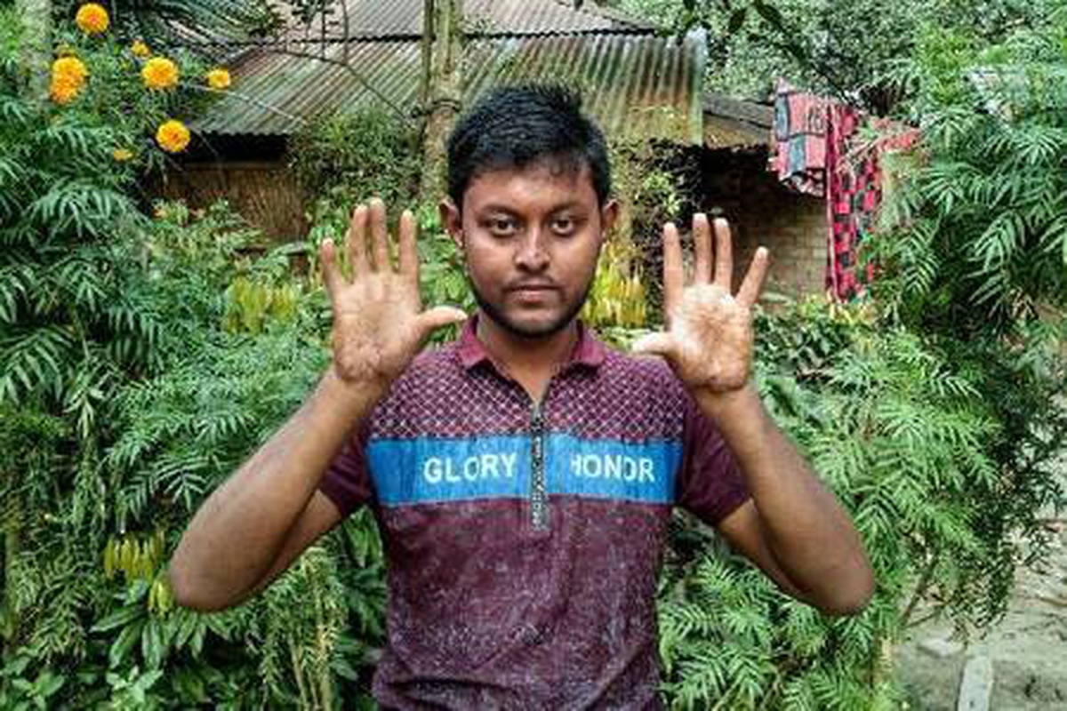 Bangladeş\'te parmak izi olmayan aile görenleri şaşkına çevirdi