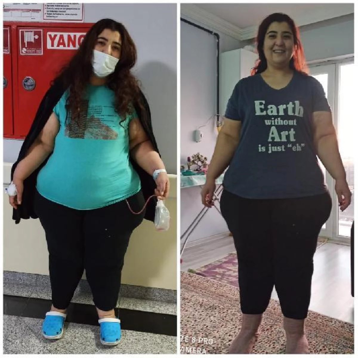 Ebe Elife, tüp mide ameliyatı sonrası bir ayda 17 kilo verdi