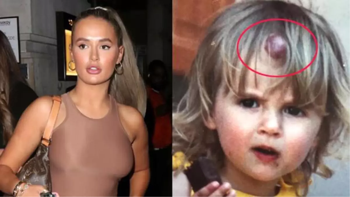 Molly- Mae Hague takipçilerini şoke etti: Alnımda böyle bir leke vardı