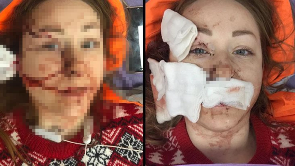 Cani koca, boşanmak isteyen Ukraynalı eşi Anna Butim\'in yüzünü falçatayla parçaladı