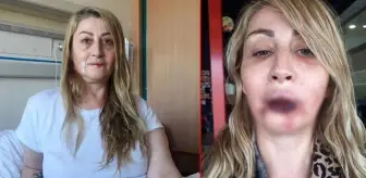 Estetik uğruna dudağını kaybeden kadın, yeniden sağlığına kavuşuyor! Bir dizi operasyonu 'ilklerin doktoru' yapıyor