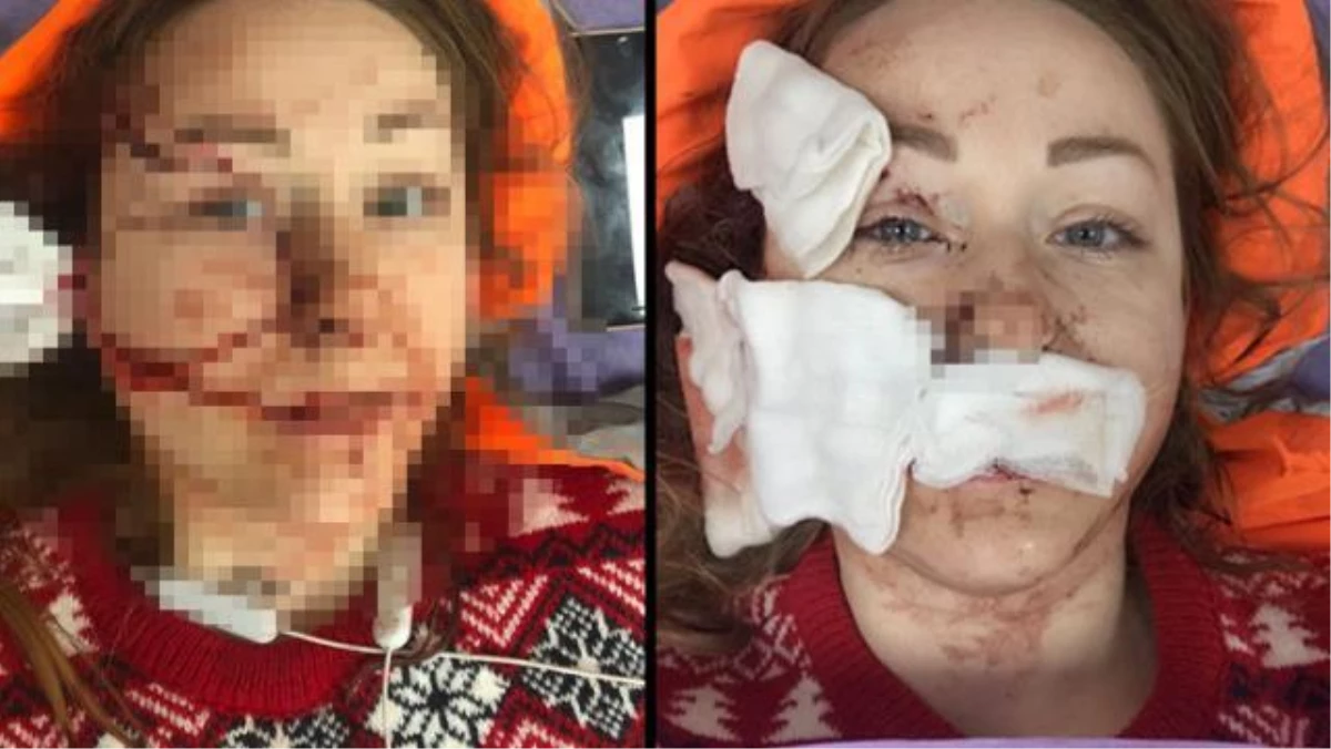 Boşanmak istediği kocası tarafından yüzü falçatayla kesilen Ukraynalı kadın: Cezaevinden erken çıkar diye çok korkuyorum