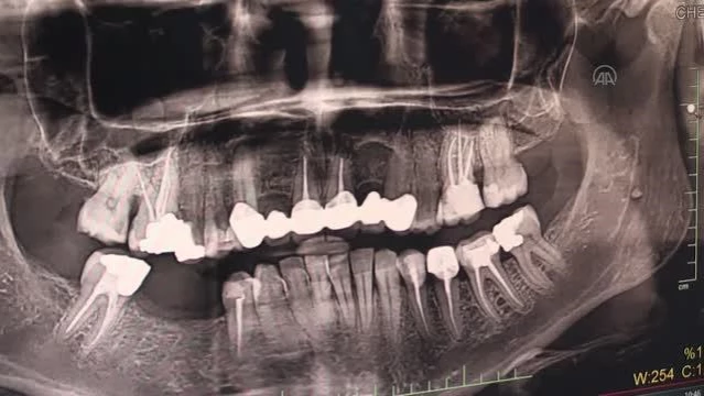 Ağız ve Diş Sağlığı Merkezinde implant tedavisi