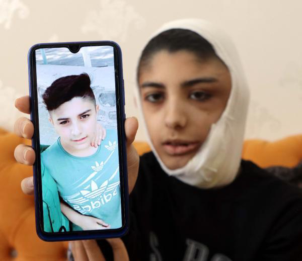 Yüzünde çıkan tümör sonrası kapanmayan yara her gün büyüyor
