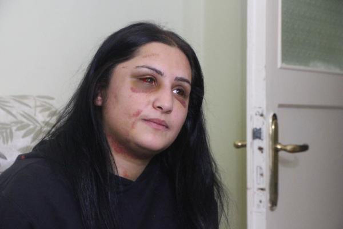 Samsun\'da eski eşinin dövdüğü kadın: Şiddet sessiz kalındıkça çoğalıyor