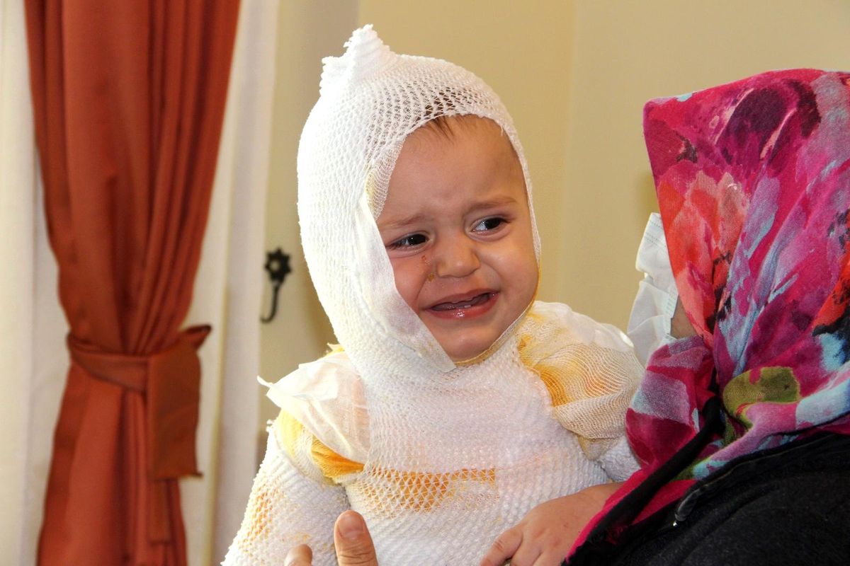 Son dakika haberi | Erzincan\'da üzerine kaynar süt dökülen çocuk hastanelik oldu