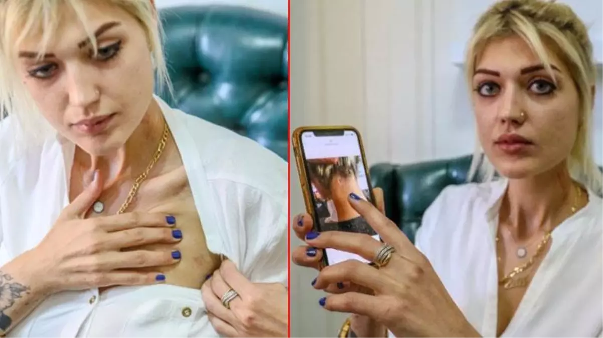 Sevgilisinin evli olduğunu öğrendi, ayrılmak isteyince ensesinden vuruldu! Genç kadın, sesini duyurmaya çalışıyor