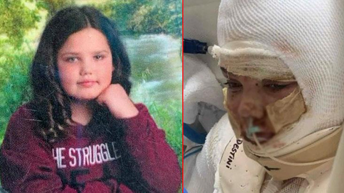 Tiktok\'taki alkolle yazı yazma akımına katılan 13 yaşındaki kız çocuğu, alevler içerisinde kaldı