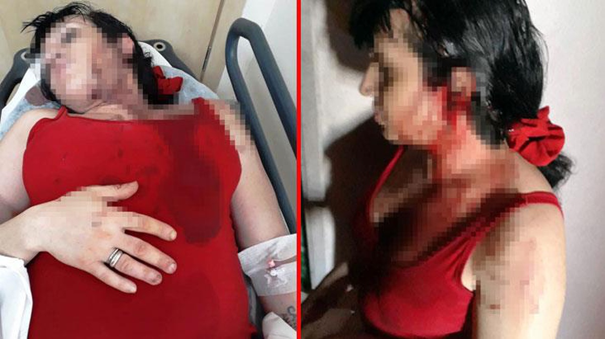 Komşuları, trans bireyi beyzbol sopasıyla dövdü