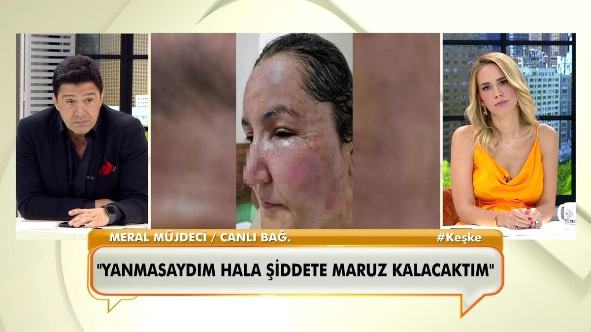 Canlı yayında bağlanan kadın, eşinin kendisini kızgın yağ ile yaktığını söyledi