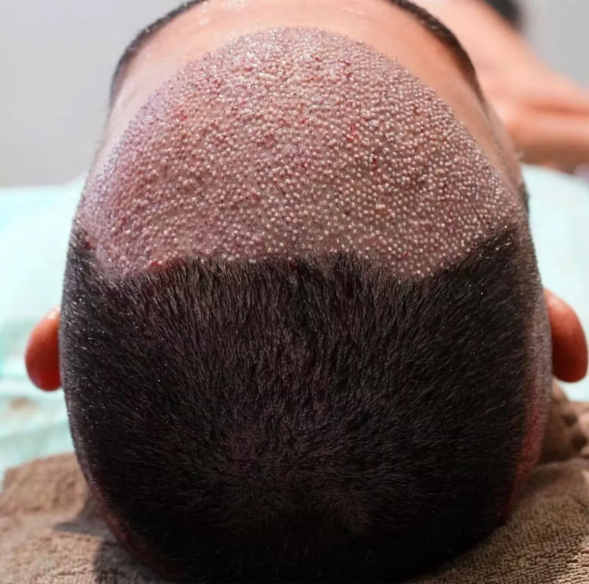 Saç ekiminde fiyatı kök miktarı belirliyor