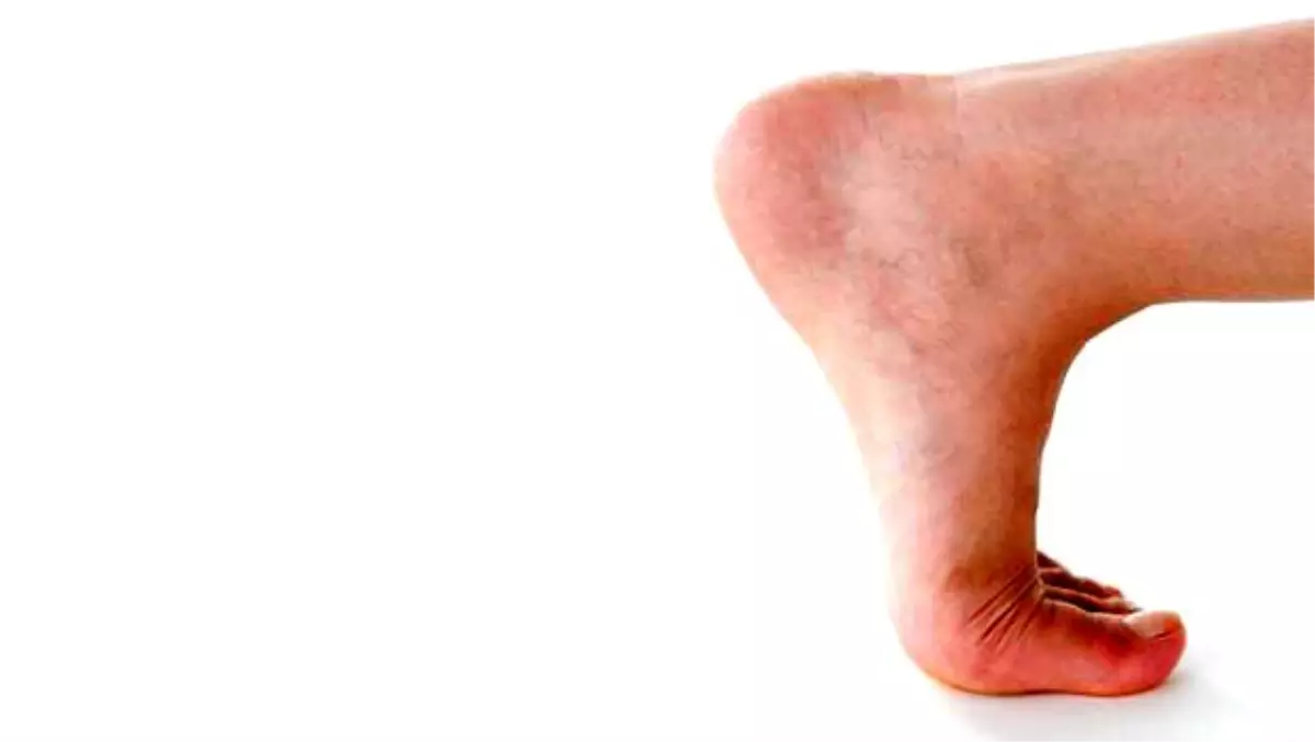 Topuk dikeni nasıl geçer? Topuk dikenine ne iyi gelir?