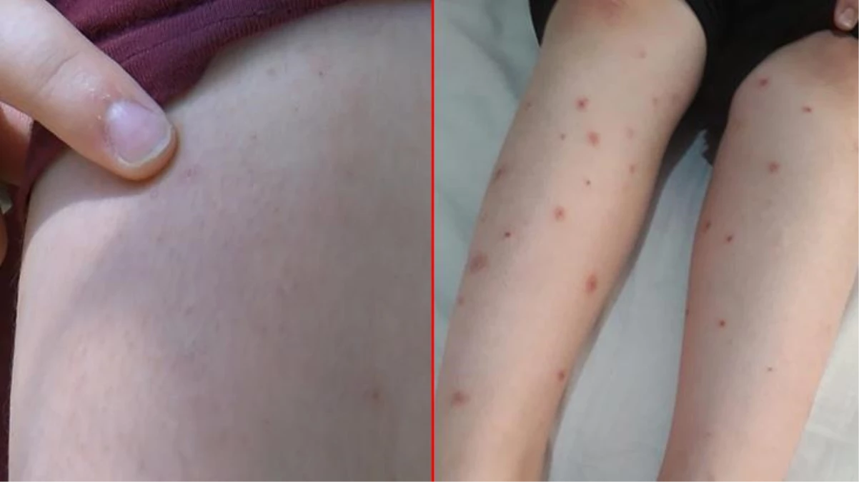 İBB\'den, İstanbullulara SMS ile uyarı! Sivrisinekler çocukların vücutlarında yara oluştutuyor