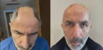 5 ay karnında taşıdığı kafatası kemikleri onu ikinci kez hayata bağladı