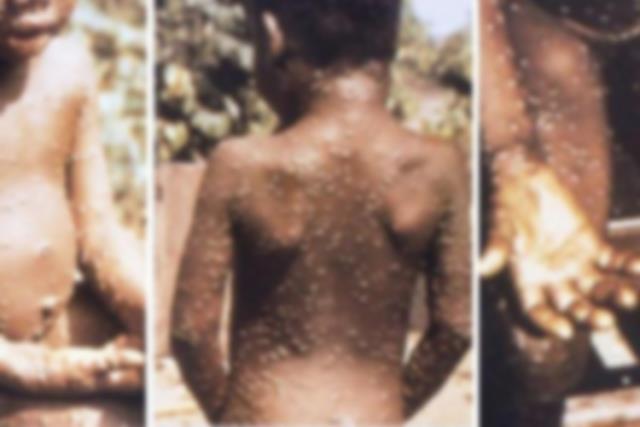 Korona bitmeden dünyanın başına bela oldu! İşte ABD'yi alarma geçiren Monkeypox'un en yaygın belirtileri