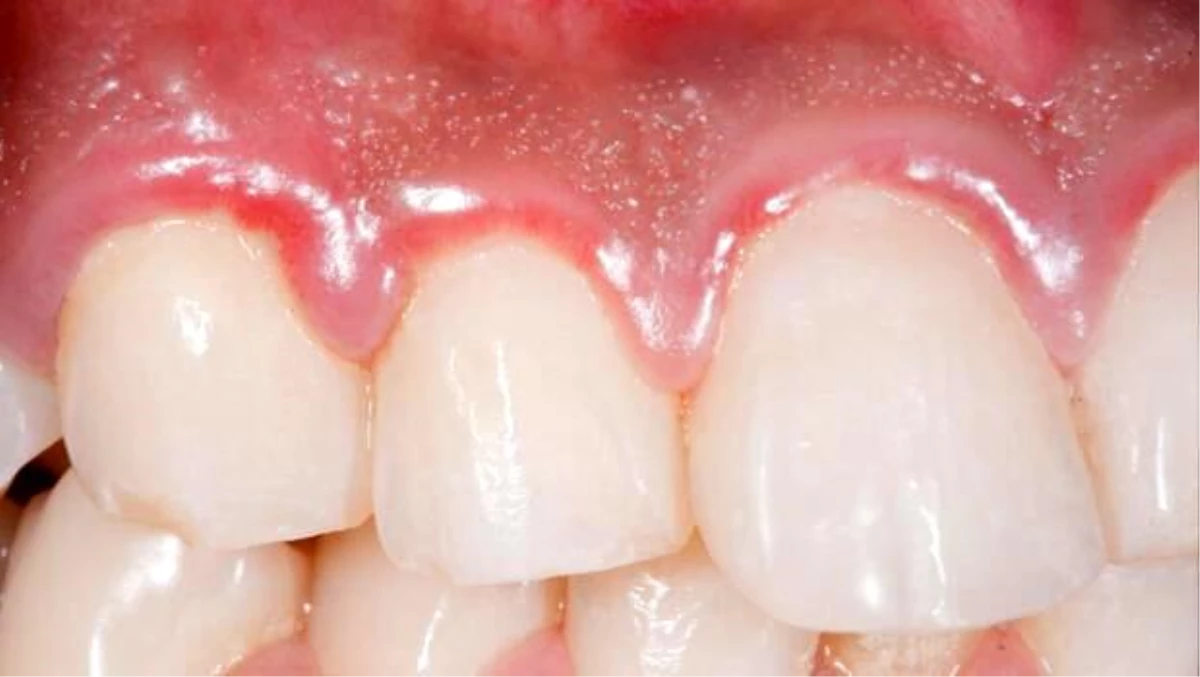 Diş iltihabına ne iyi gelir ve nasıl geçer? Diş iltihabı neden olur? Evde diş iltihabına iyi gelen bitkisel ve doğal yollar