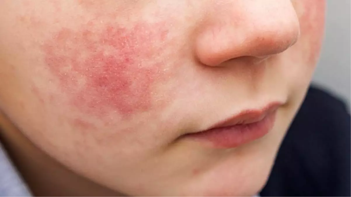 Uzmanlar uyarıyor: Çocuğunuz kırmızı yanaklı ise dikkat; bulaşıcı olabilir