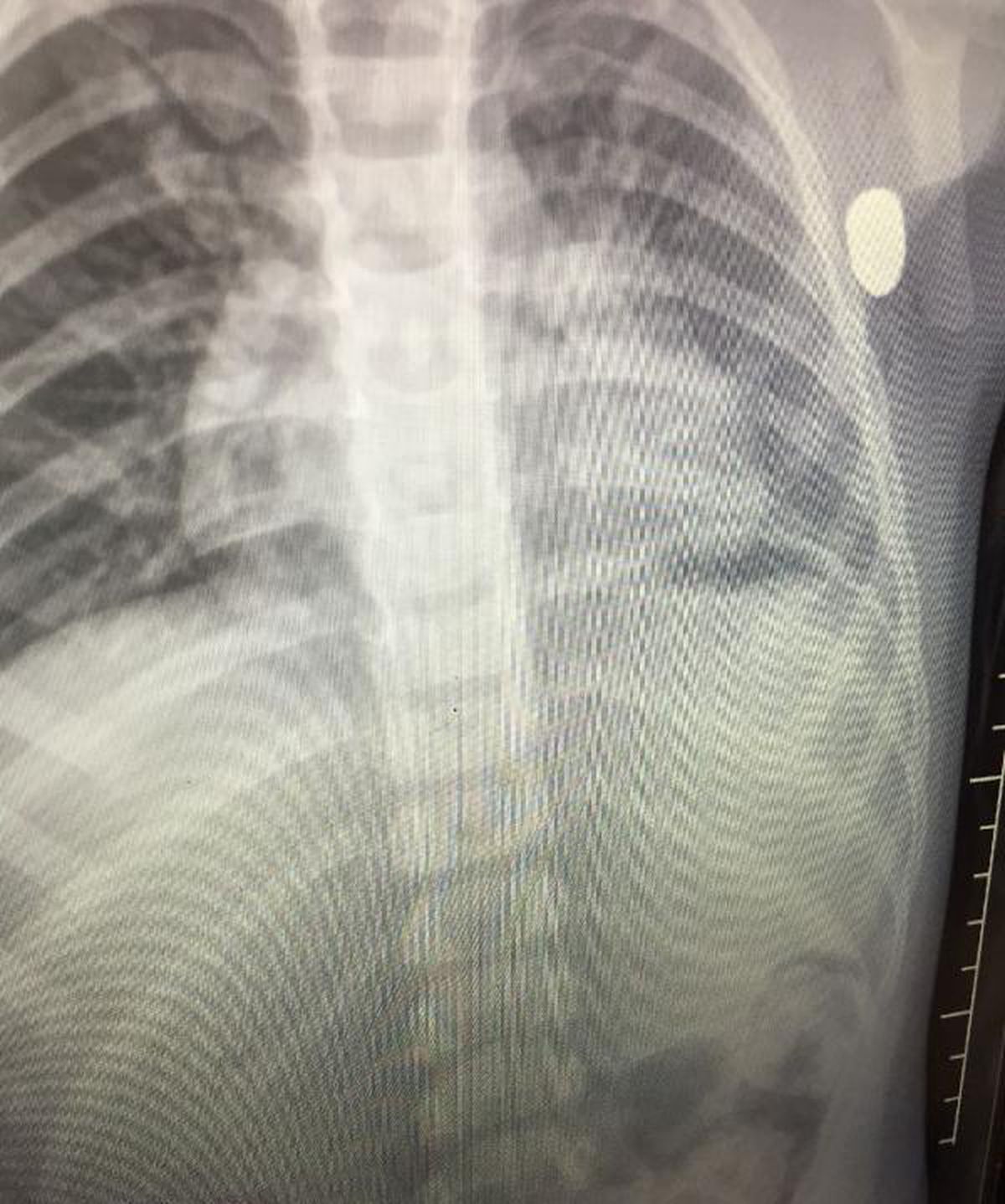 Salıncakta göğsüne 'yorgun mermi' isabet eden Emir, ağır yaralandı