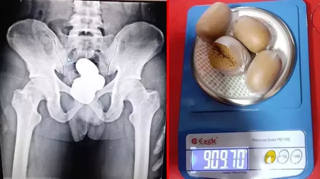 Havalimanında yakalanan kaçakçının makatından 4 kapsül halinde 1 kiloya yakın altın çıktı Havalimanında yakalanan kaçakçının makatından 4 kapsül halinde 1 kiloya yakın altın çıktı