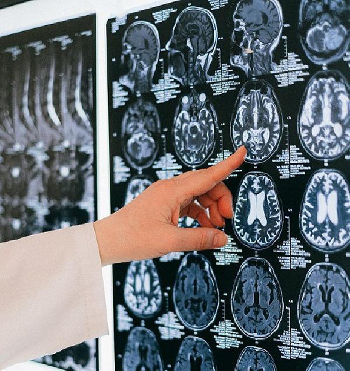 Serebral palsi; çocuklarda ilk 3 yaşa dikkat