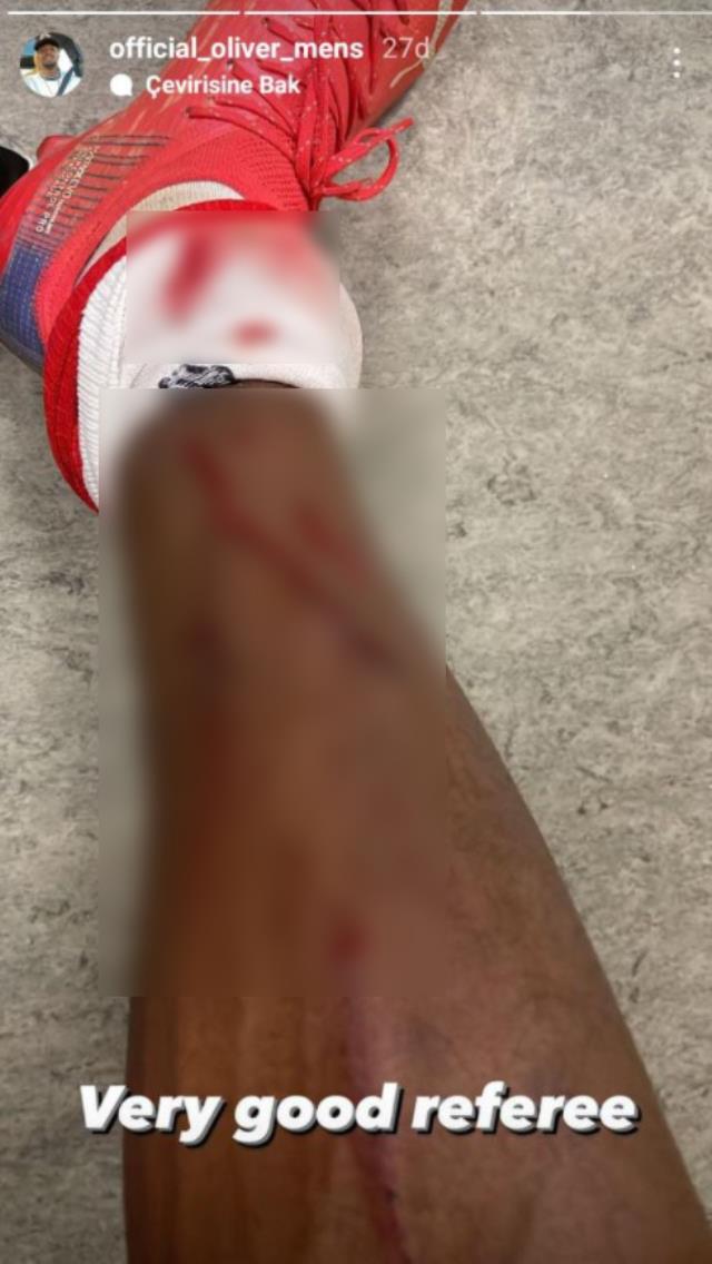 Kayserispor'un kaptanı Bernard Mensah, Konyaspor yenilgisinin ardından kanlar içinde kalan bacağını paylaştı