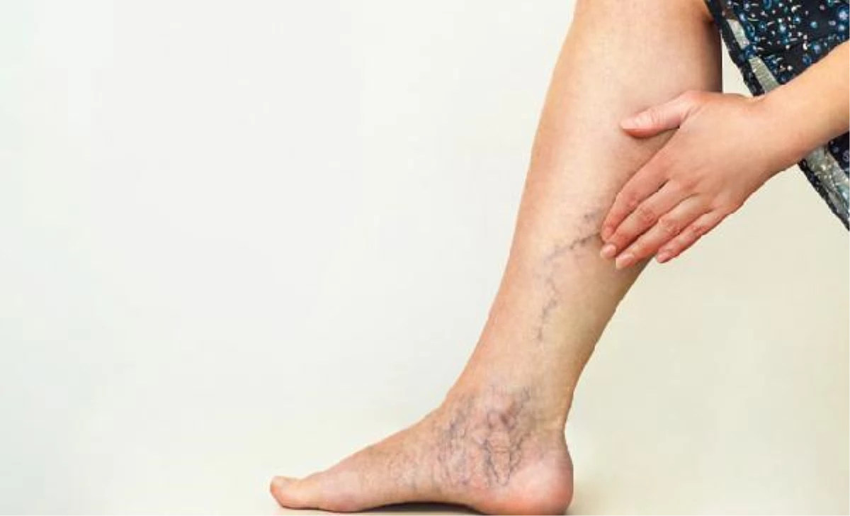 "Problem of varicose veins can be solved to 99 percent with painless laser treatment"